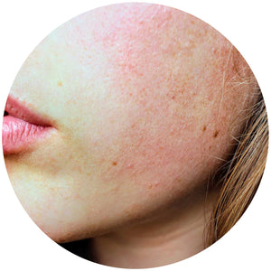 No B.S. Skin Care Guide for Sensitive Skin