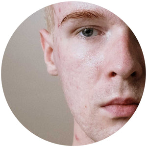 No B.S. Skin Care Guide for Acne-Prone Skin