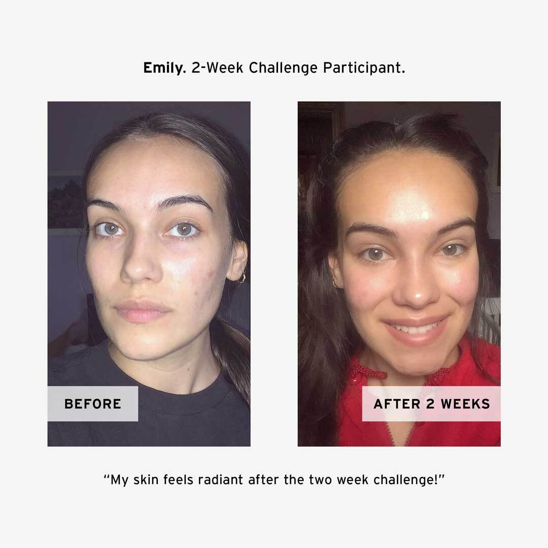 Emily's Before and After using No BS Skincare COQ10 Antioxidant Cream 