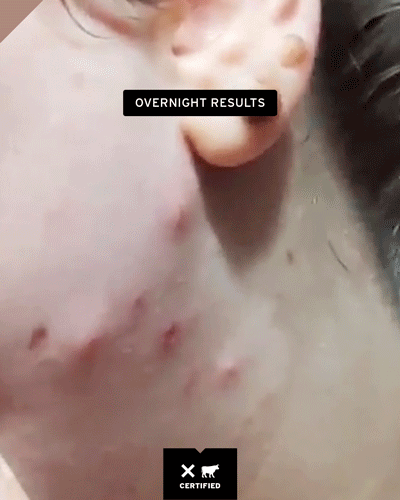 Intensive Overnight Pimple Patches
