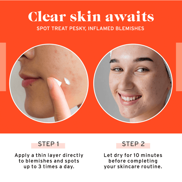 Acne Spot Treatment