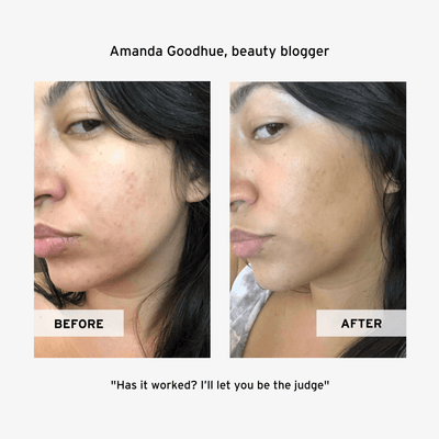 Amanda Goodhue's No BS Skincare Hyaluronic Serum Before and After